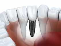 50% скидки на каждый второй зубной имплант