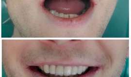 Протезирование зубов в Черкассах - стоматология Джулия